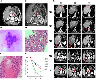 Making “cold” tumors “hot”- radiotherapy remodels the tumor immune microenvironment of pancreatic cancer to benefit from immunotherapy: a case report